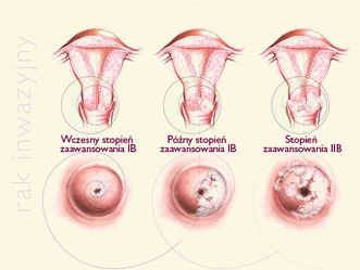 hpv zmiany na szyjce macicy)